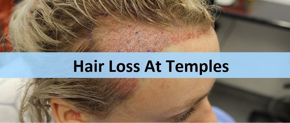 Hair loss temples female young